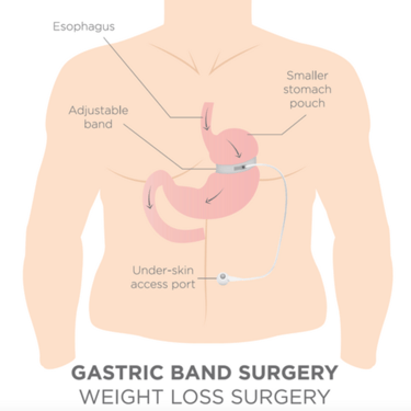 a diagram of gastric band surgery with an adjustable band on the stomach