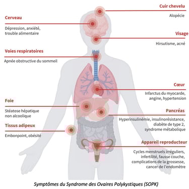PESTICIDES SANTÉ FEMMES SYNDROME OVAIRES POLYKYSTIQUES