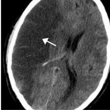 A stroke may damage the tissue that produces obstruction CSF or block the flow of CSF