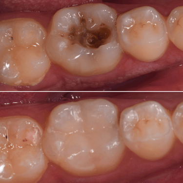 Deep teeth cavity treated with tooth colored filling of bonded composite resin by best dentist in malad west