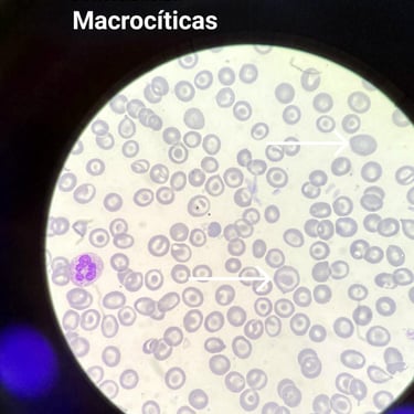 Macrocitose