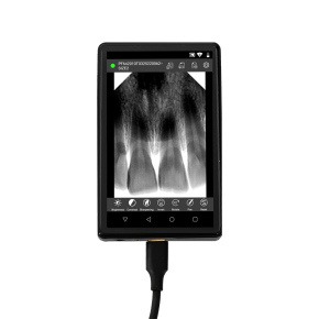 Digital dental X-ray sensor displaying a tooth radiograph on a handheld monitor screen.
