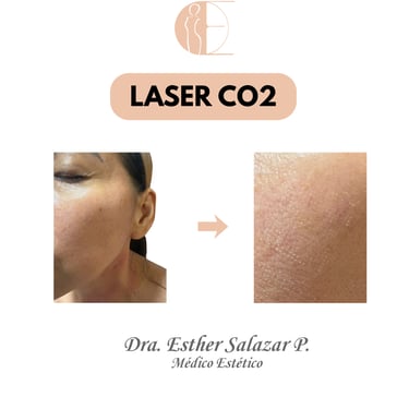 LASER CO2 GUAYAQUIL