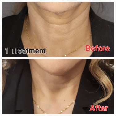 Results showing neck skin tightening and reduced wrinkles after one RF Microneedle treatment.