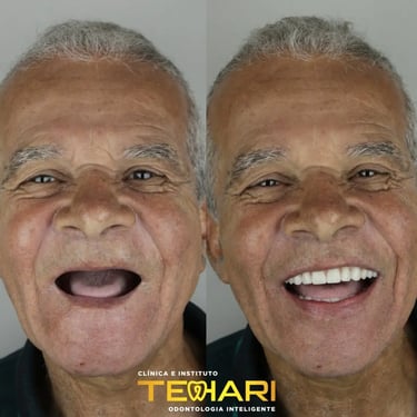 Antes e depois de Implante dentário em Osasco e Americana, Tehari Odontologia