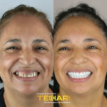 Faceta em Porcelana em Osasco e Americana São Paulo