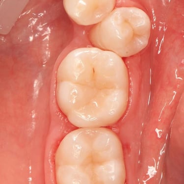 "tooth extraction near me veneers near me veneers implants best teeth whitening near me"