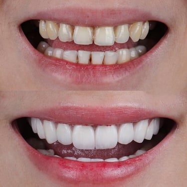 "CosmeticDentistry best dental clinic in vashi last teeth removal invisalign aligners near me"