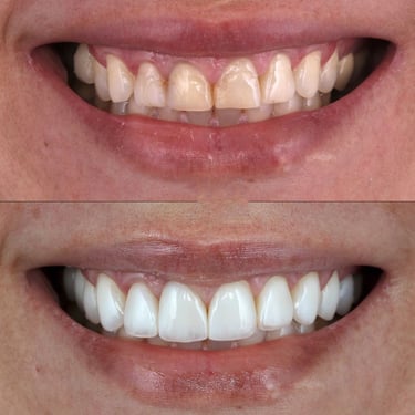 ''teeth whitening near me, brighten teeth, white teeth, best dental clinic near me for teeth whiteni