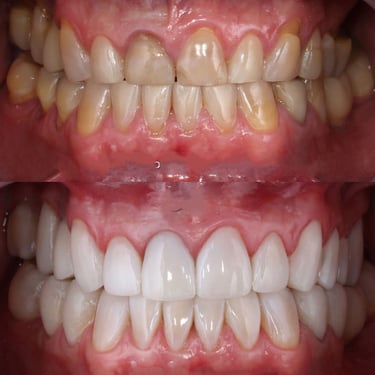 smile makeover, smile correction, smile designingdental treatments at low cost invisible braces"
