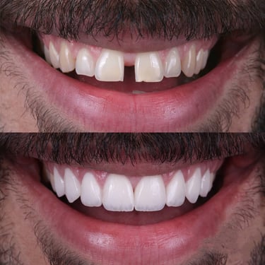 "ceramic cap price MouthGuard free dental care clinic digitaldentistry toothsi aligners"