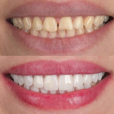 "white teeth, natural ways to whiten teeth, affordable dental clinic near me,teeth polishing
