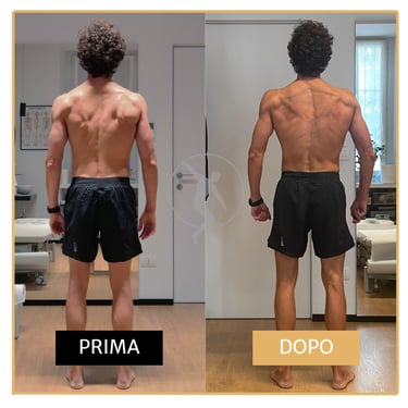 Riduzione curve scoliosi in uomo di 40 anni Performa Specialists By Dott. Alessandro