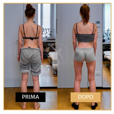 Risoluzione scapole alate ragazza di 17 anni Performa Specialists by Dott. Rossin
