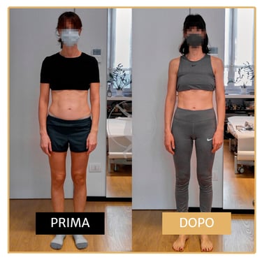 Risoluzione diastasi addominale post-cesareo  donna di 40 anni Performa Specialists by Dott. Rossin