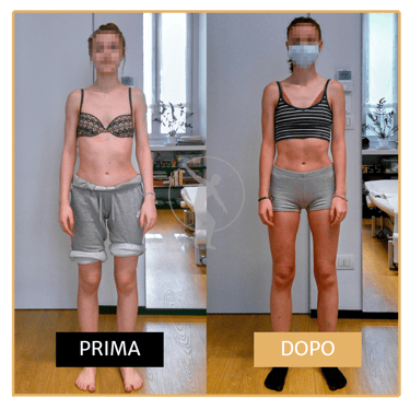 Risoluzione scoliosi adolescenziale ragazza di 17 anni Performa Specialists by Dott. Rossin