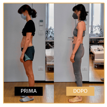 Miglioramento posturale post cesareo donna di 40 anni Performa Specialists by Dott. Rossin