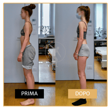 Miglioramento posturale ragazza di 17 anni Performa Specialists by Dott. Rossin