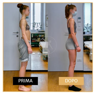 Risoluzione pectum excavatum ragazza di 17 anni Performa Specialists by Dott. Rossin
