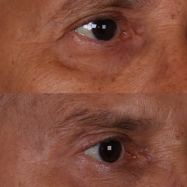 preenchimento olheiras viva clinica integrada