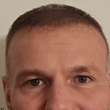 a man after his anti wrinkle injections treatment