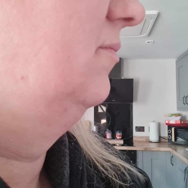 a women before her weight loss treatment