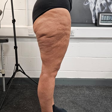 a women before her weight loss injections treatment