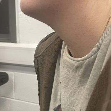 a women before her weight loss treatment