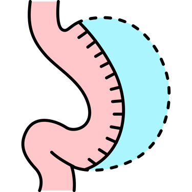 sleeve gastrectomy