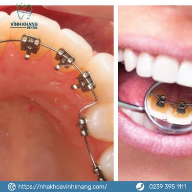 Mắc cài mặt lưỡi