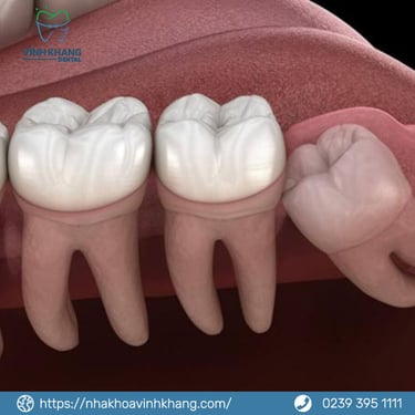 Những Lý Do Chính Để Nhổ Răng Khôn