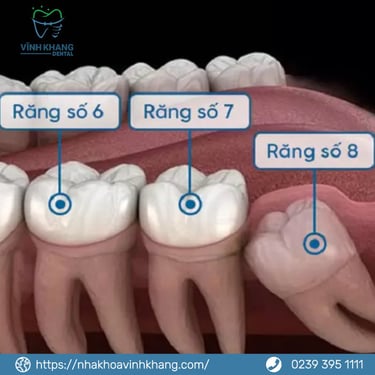 Những Lý Do Chính Để Nhổ Răng Khôn