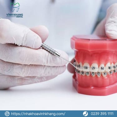 Ưu – nhược điểm của các loại mắc cài niềng răng
