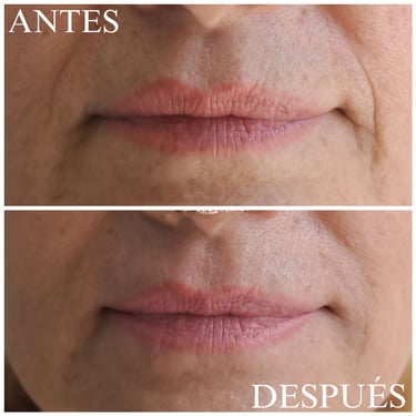 Relleno ácido hialurónico pliegues nasogenianos antes y después
