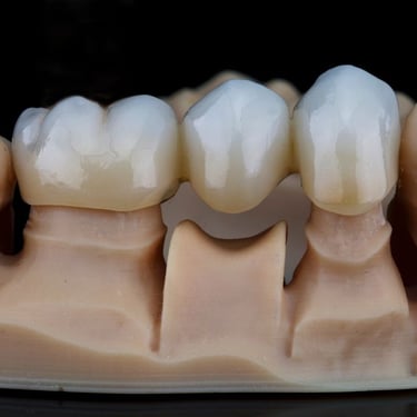 dental bridge