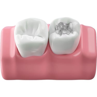 dental filling