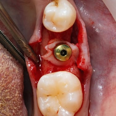 flap surgery
