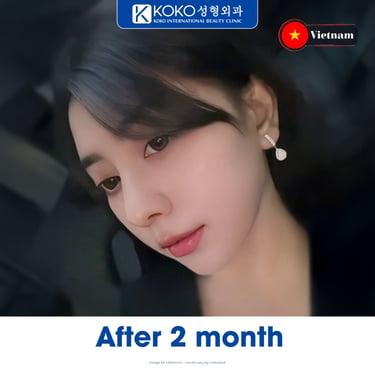 Natural rhinoplasty transformation showing improved facial harmony