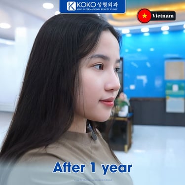 Asian rhinoplasty before and after transformation