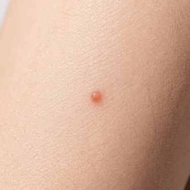 Macro clinical close-up of a small skin blemish before removal, sterile lighting, macro texture