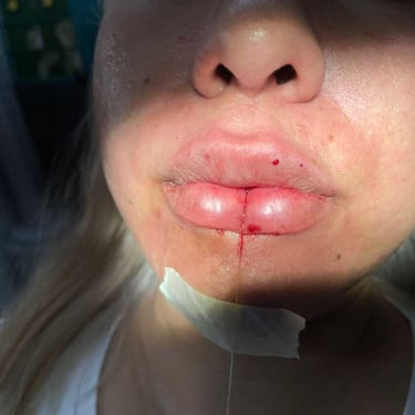 Labios en tratamiento de botox y ácido hialuronico