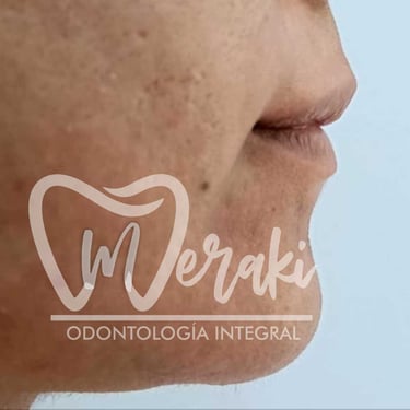 Persona antes del tratamiento de botox