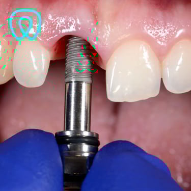 Implante dental