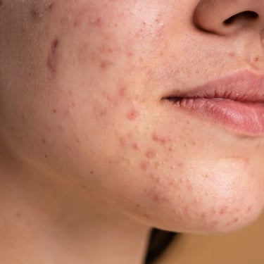 confident young woman with acne close up