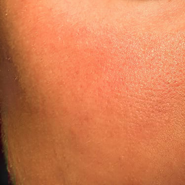 Skin showing some redness or irritation.