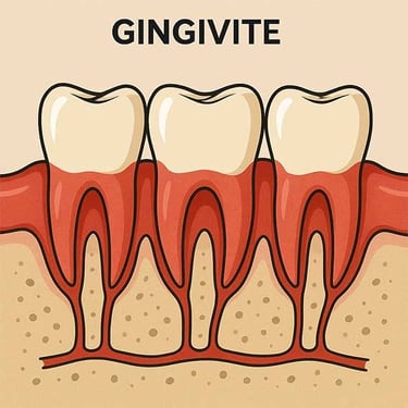 Parodontie la gingivite hygiene-precision.com