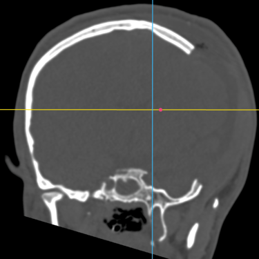  craneoplastia- reconstruccion de calota craneal-dr. tafur -neuro -- neurocirugia- mejor neurocirujano