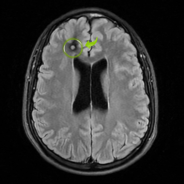 cavernoma cerebral, lesion vascular de manejo por neurocirugia, dr tafur, mejor neurocirujano