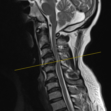 columna cervical- mielopatia compresiva- estenosis severa- dr tafur -neuro-neurocirugia- mejor neurocirujano (7)