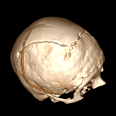 Craneoplastia- dr. david tafur - defecto de craneo